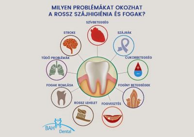 Gócbetegségek rossz fogak miatt